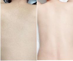 -薇兰专业脱毛连锁机构