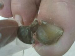 -祖传修脚甲沟炎灰指甲鸡眼
