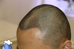 -大麦微针植发丨全国连锁