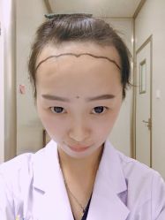 -大麦微针植发丨全国连锁