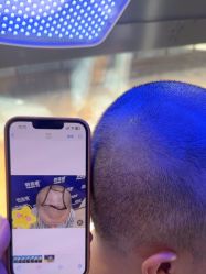 -碧莲盛·不剃发植发