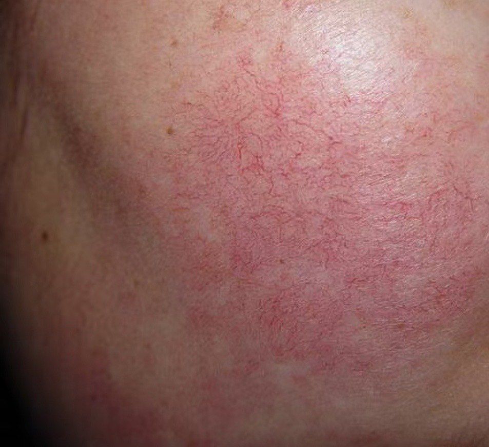 当天气温度突然变冷时,皮肤不耐受,从而也引发毛细血管发生变化