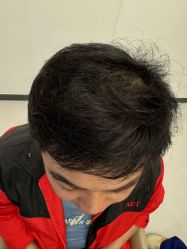 -大麦微针植发全国连锁