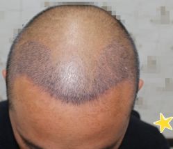 -大麦微针植发丨全国连锁