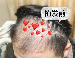 -大麦微针植发全国连锁