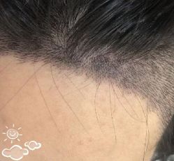 -大麦微针植发丨全国连锁