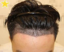 -大麦微针植发丨全国连锁