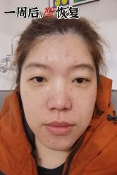 -广州健丽·去眼袋医疗美容机构