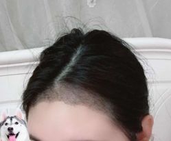 -大麦微针植发丨全国连锁