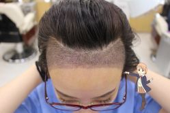 -大麦微针植发丨全国连锁