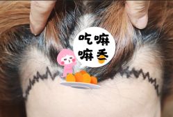 -大麦微针植发全国连锁