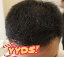 -大麦微针植发丨全国连锁