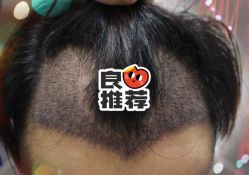 -大麦微针植发全国连锁