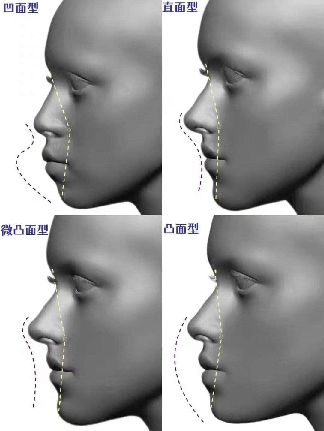 颌面重要性
凹面型脸苦相
凸面型