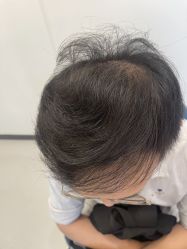 体验后-大麦微针植发全国连锁