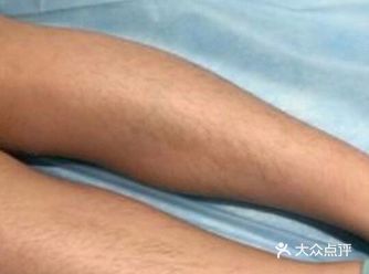 体毛拜拜！零感冰点脱毛经历分享