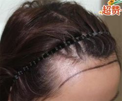 -大麦微针植发全国连锁