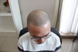 -大麦微针植发丨全国连锁