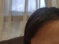 -碧莲盛·不剃发植发