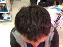 -大麦微针植发全国连锁