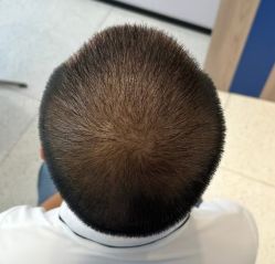 -大麦微针植发丨全国连锁