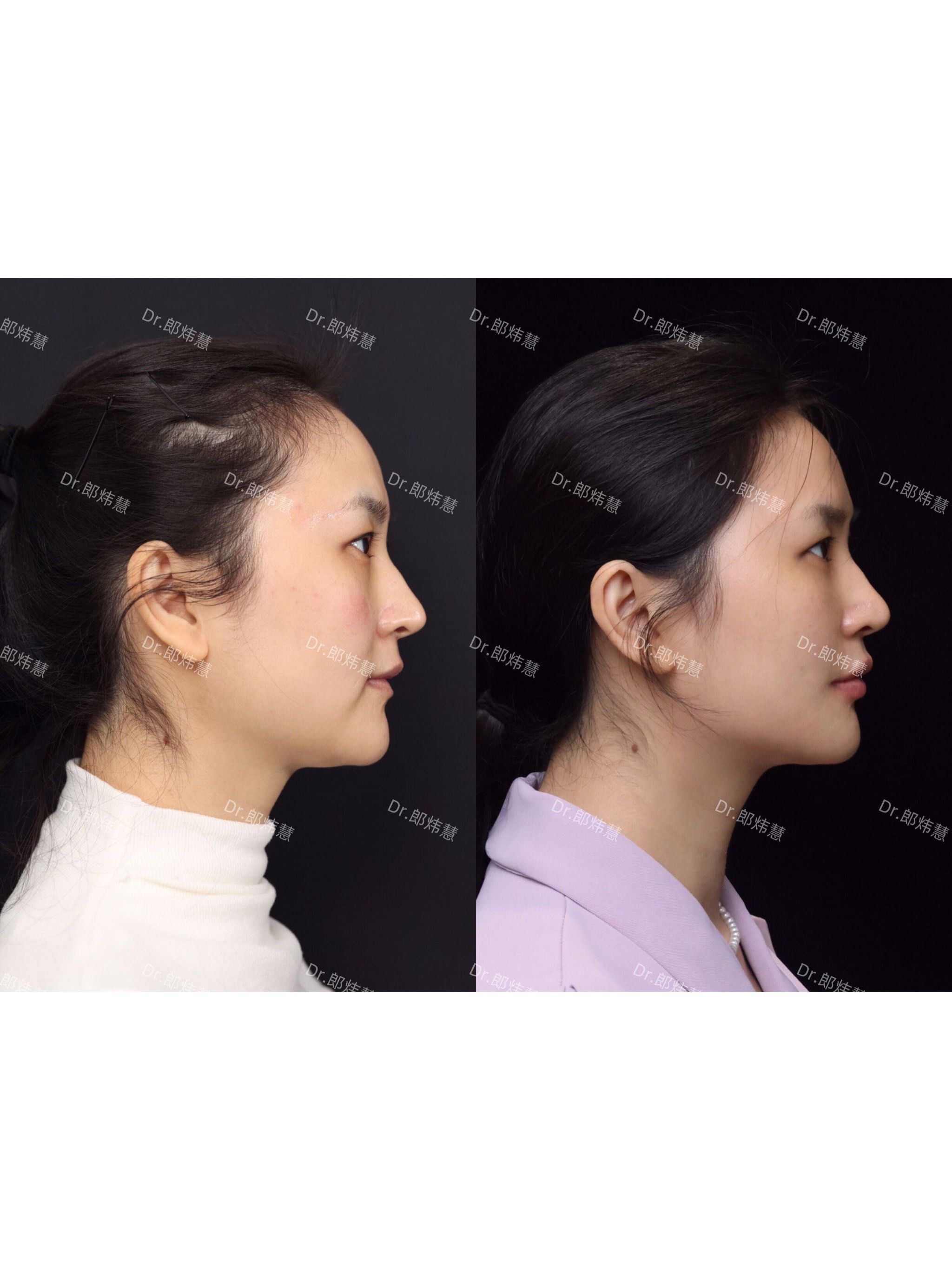 的公主玻尿酸做发际线和太阳穴以及整个颞区塑造饱满度;
下v区:下颏