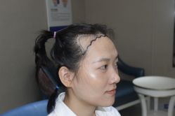 点击看大图 -大麦微针植发丨全国连锁