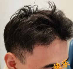 -大麦微针植发丨全国连锁