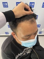 体验后-大麦微针植发全国连锁