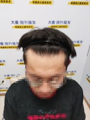 -大麦微针植发丨全国连锁