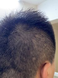 点击看大图 体验后-熙朵美学植发连锁
