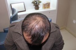 -大麦微针植发全国连锁