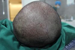 点击看大图 -大麦微针植发丨全国连锁