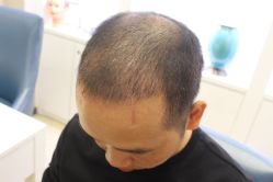 -大麦微针植发丨全国连锁