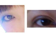 小内双和整后比较-上海华安整形外科门诊部