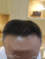 -大麦微针植发丨全国连锁