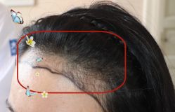 -大麦微针植发全国连锁