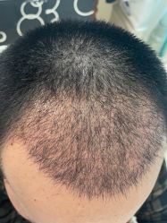 点击看大图 -碧莲盛·不剃发植发