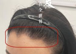 -大麦微针植发全国连锁