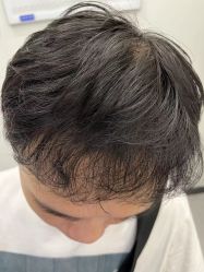 -大麦微针植发全国连锁