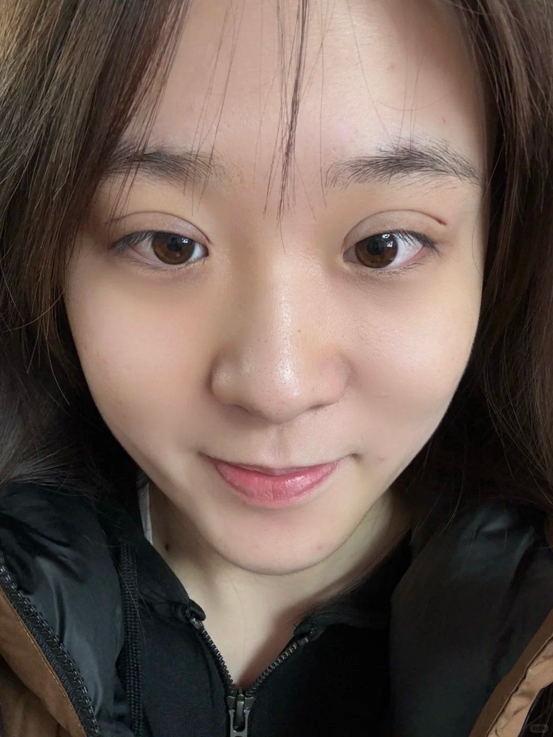 埋线双眼皮即刻