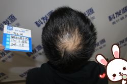 -大麦微针植发丨全国连锁