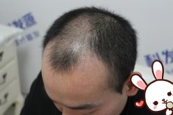 点击看大图 -大麦微针植发丨全国连锁