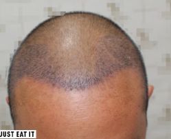 -大麦微针植发丨全国连锁