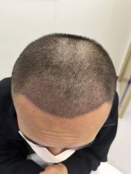 -大麦微针植发全国连锁