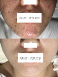-美肤盾祛痘·问题肌头疗管理中心