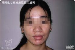 -韩医生专业祛痘连锁机构