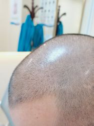 点击看大图 体验后-碧莲盛·不剃发植发