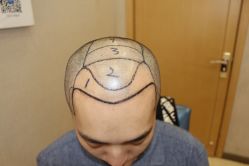 -大麦微针植发丨全国连锁