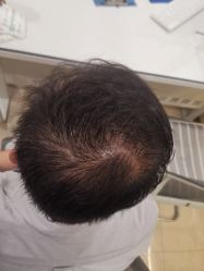 点击看大图 -碧莲盛·不剃发植发